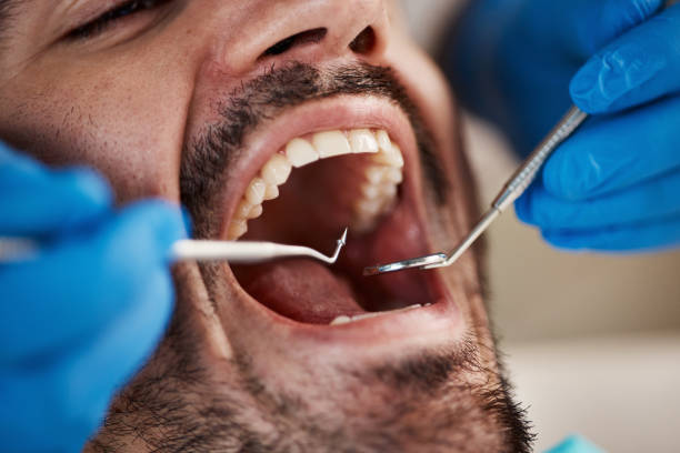 Best Emergency Dentist for Lost Fillings or Crowns in Millwood, WA
